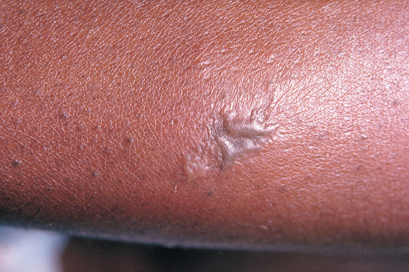 leziune gonoree - wiki