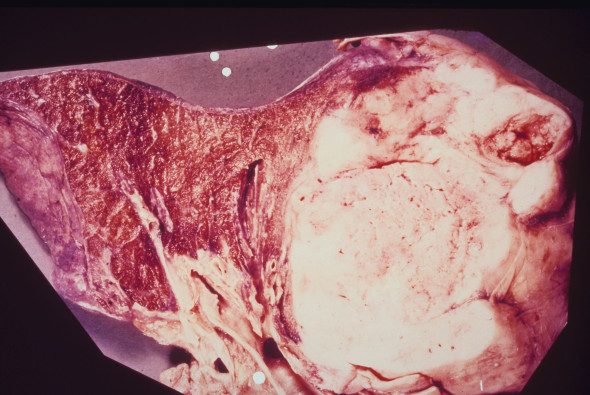 Cancer Images