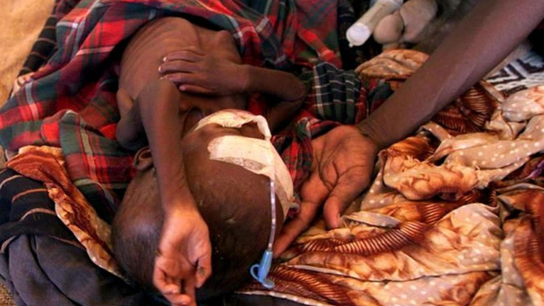 Copil subnutrit într-un spital din Etiopia.