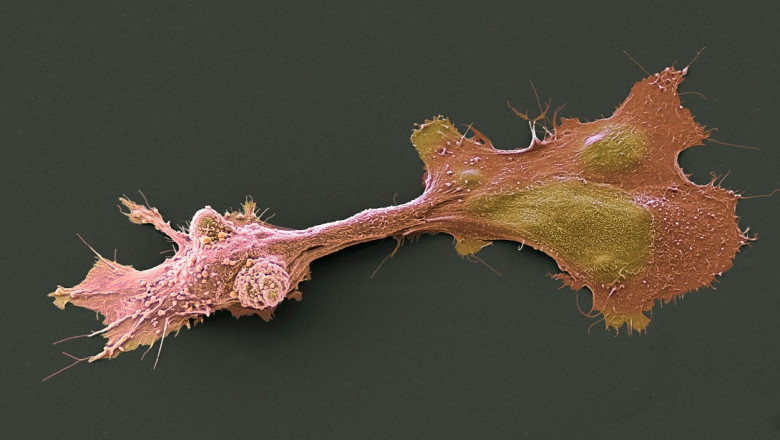 celule cancer