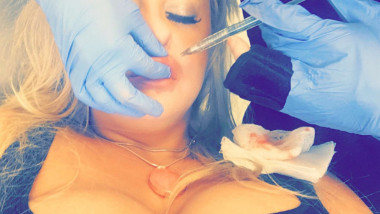 Un medic face o injecție cu botox în buzele unei femei.