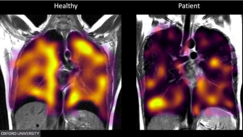 radiografii plămâni