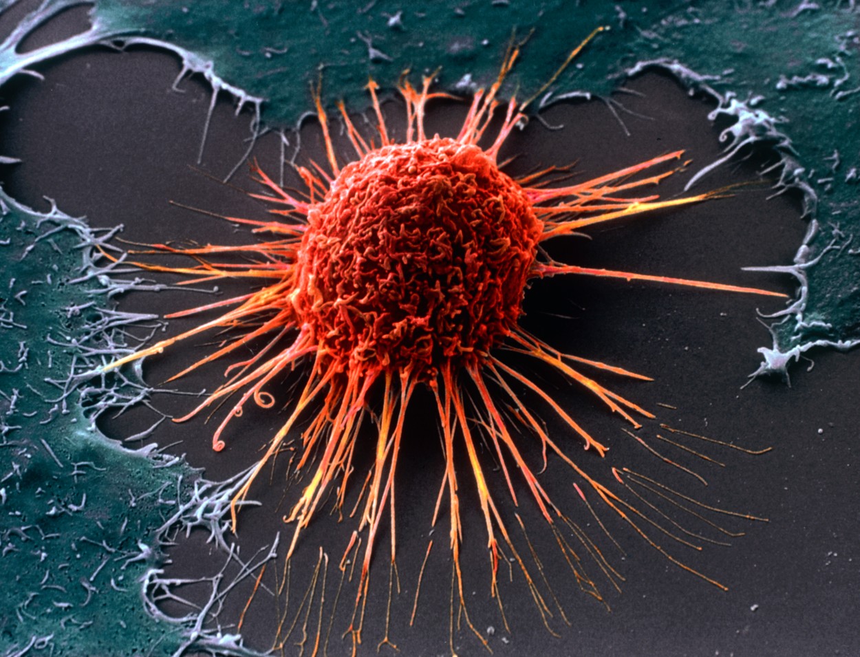 Un test „revoluţionar” ar putea detecta riscul de a dezvolta patru tipuri de cancer la femei