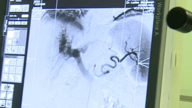 operatie hepatica in premiera targu mures captura digi24 07 08 2015