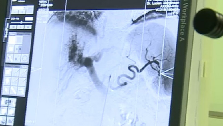 operatie hepatica in premiera targu mures captura digi24 07 08 2015