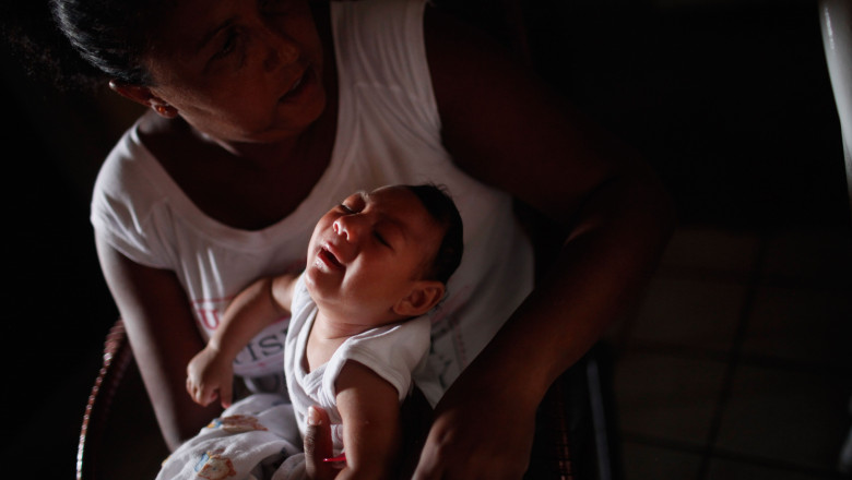 copil cu microcefalie dupa infectarea cu zika
