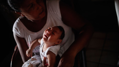 copil cu microcefalie dupa infectarea cu zika