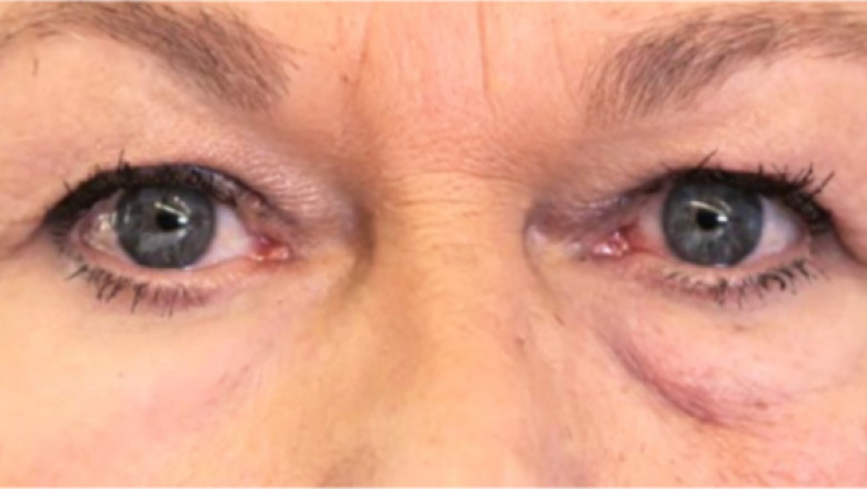 Pungi sub ochi: 8 cauze, prevenție și tratament