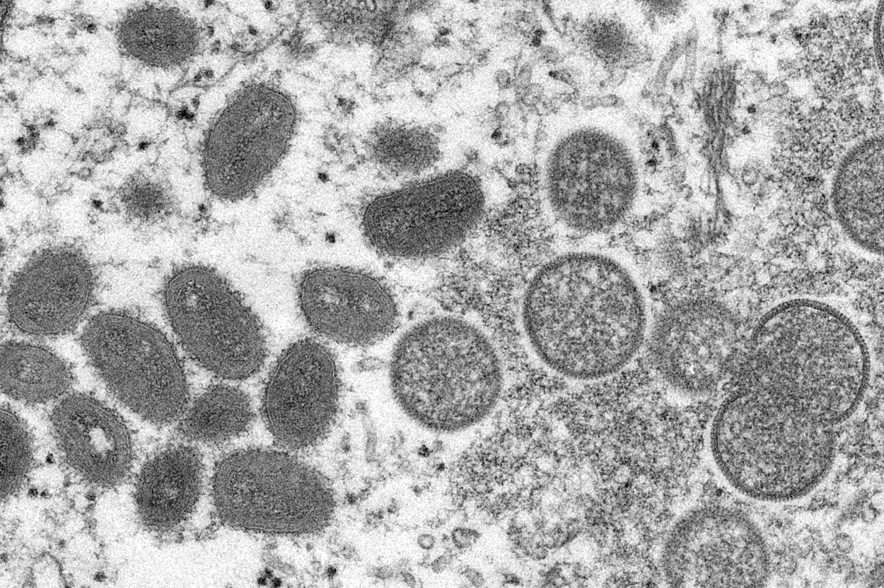 3 cazuri noi de variola maimuţei au fost diagnosticate in Romania