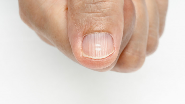 Cum să tratezi golul sub unghie acasă. Golul sub unghie. De ce apare aceasta boala?