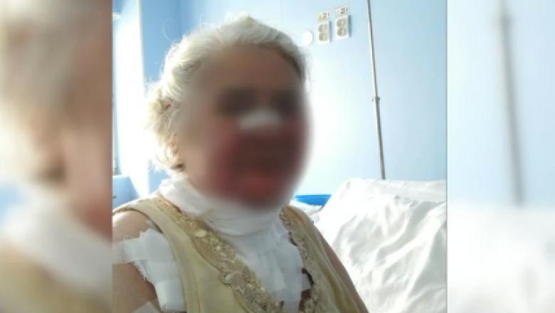 Politia face ancheta in cazul femeii arse la fata la Spitalul Sfanta Maria din Capitala. Manager: Pacienta e bine, ne-a multumit