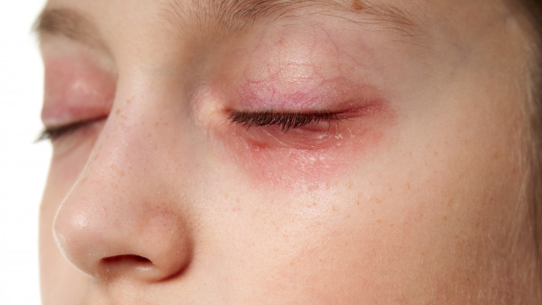 Allergic reaction, skin rash, close view portrait of a girl's face. Redness and inflammation of the skin in the eyes and lips. Immune system disease.