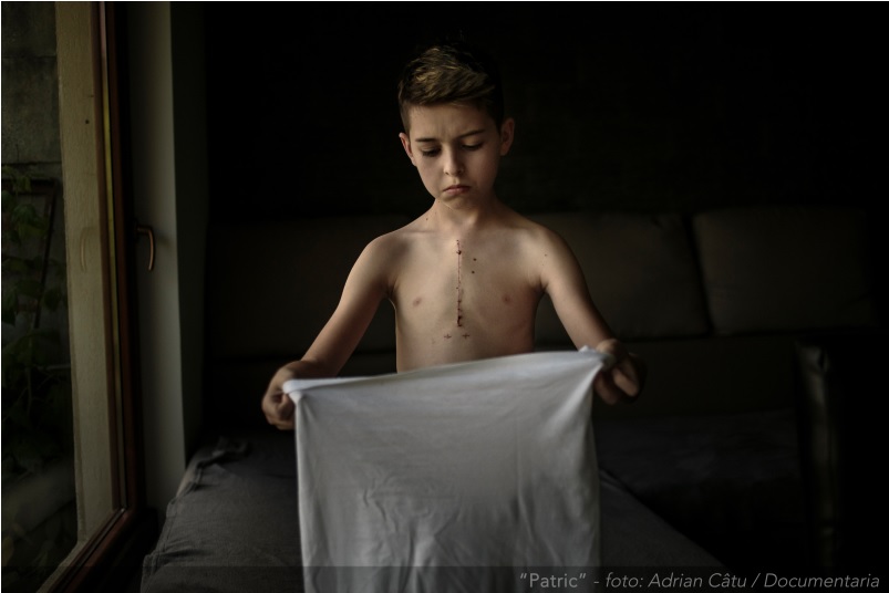 Adrian Câtu câștigă un premiu de excelență la un concurs internațional, pentru o fotografie cu un copil operat