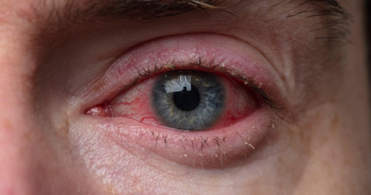 Ochii roşii pot evidenţia probleme de sănătate - Blog de optica medicala | marigold.ro