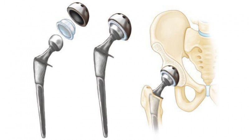 Reparatii de cartilaj suplimente sportive conuri de pin pentru dureri articulare