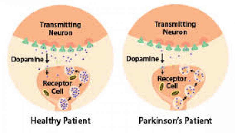 parkinson