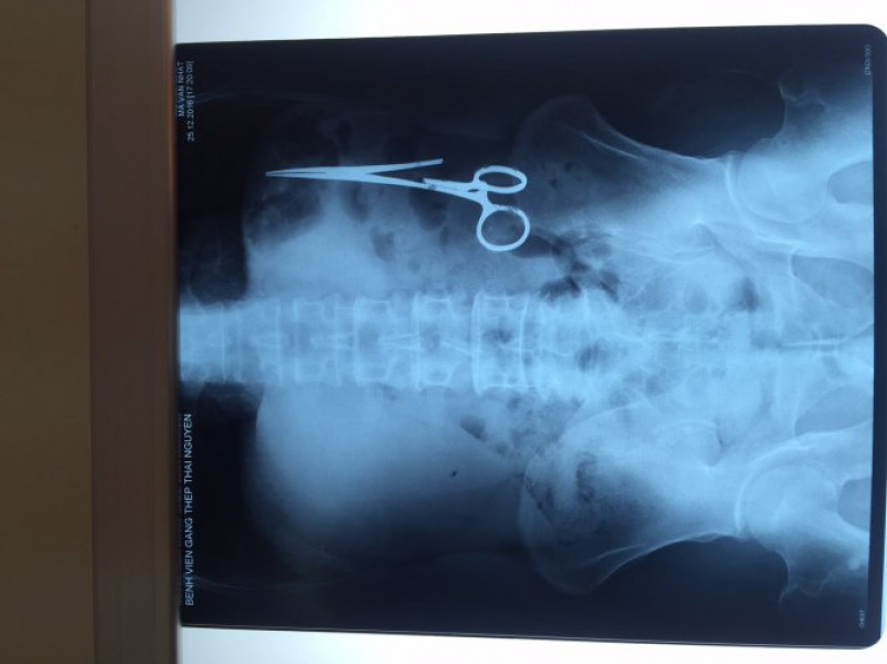 radiografie barbat cu foarfeca in abdomen