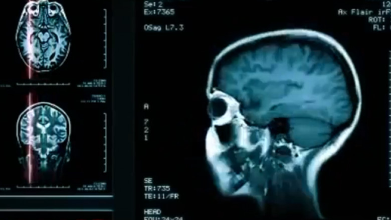 creier radiografie