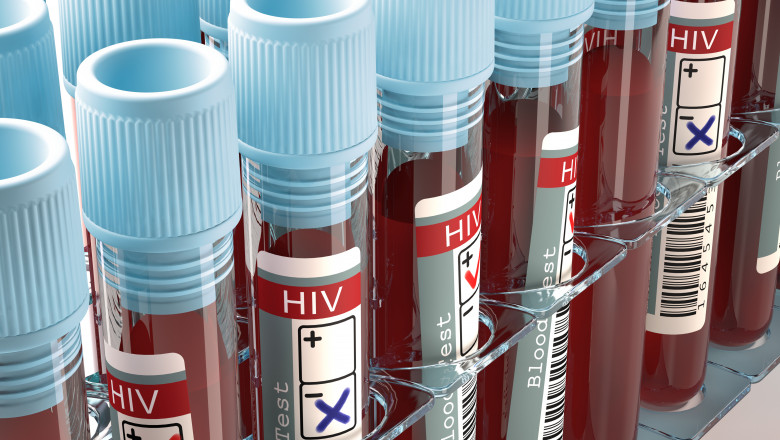 sange hiv sida analize