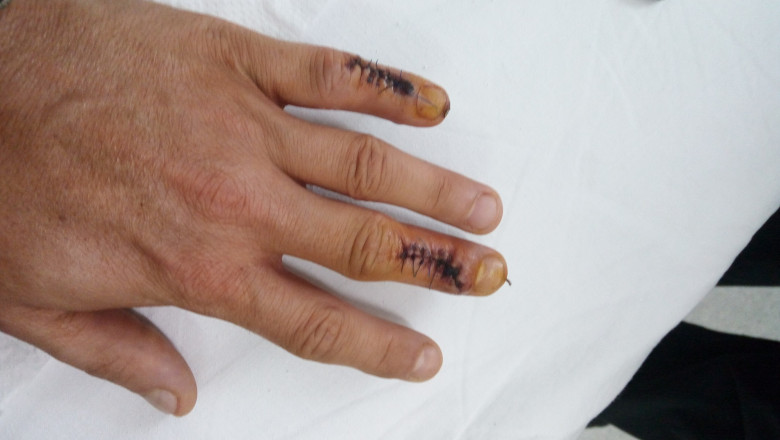 Durerea articulară în degetul mijlociu și inelul. Dureri de articulație degetul mijlociu