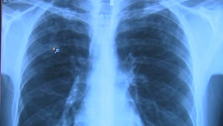 radiografie plamani oms tuberculoza 29 10 2015