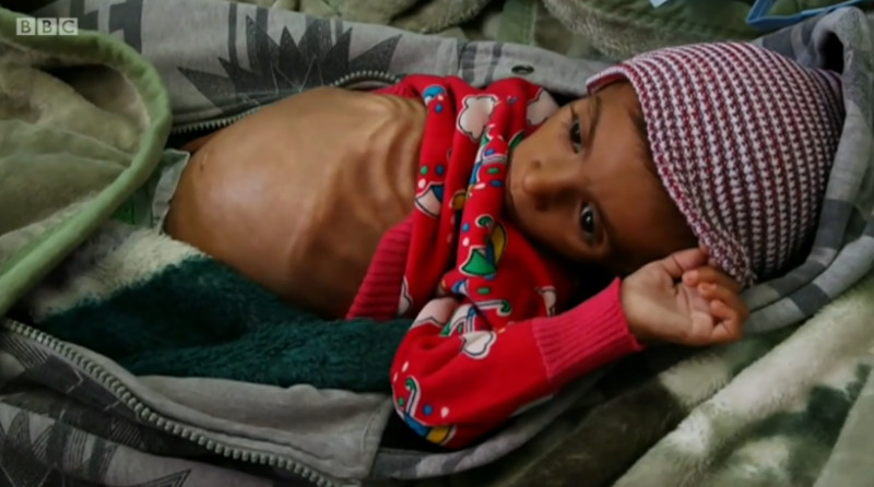 copil inanitie yemen_captura bbc