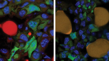 celule cancer grasime