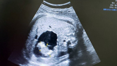fetus in fetu columbia