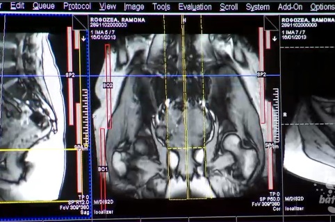 Cum apare si cum se trateaza hernia de disc. Simptomele care trebuie sa ne ingrijoreze