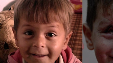 Joouma, copil sirian mutilat după un atac aerian