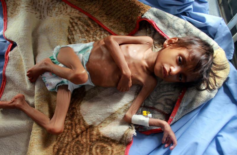 copil suferind de foame yemen profimedia-0540720427