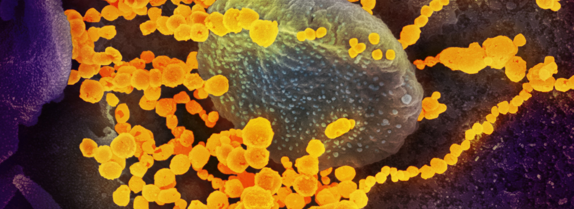 Novel coronavirus sars-cov-2