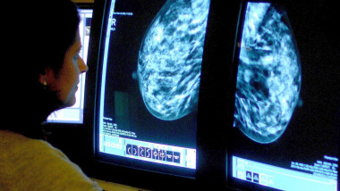 un medic studiaza radiografia unui pacient cu cancer