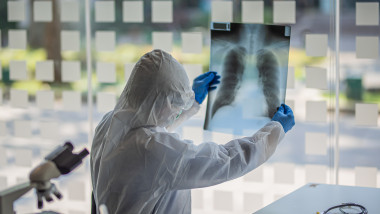 Doctor care se uita la o radiografie a plămânilor