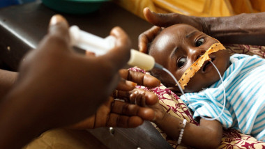 Copil malnutrit hrănit cu lapte cu ajutorul unui tub