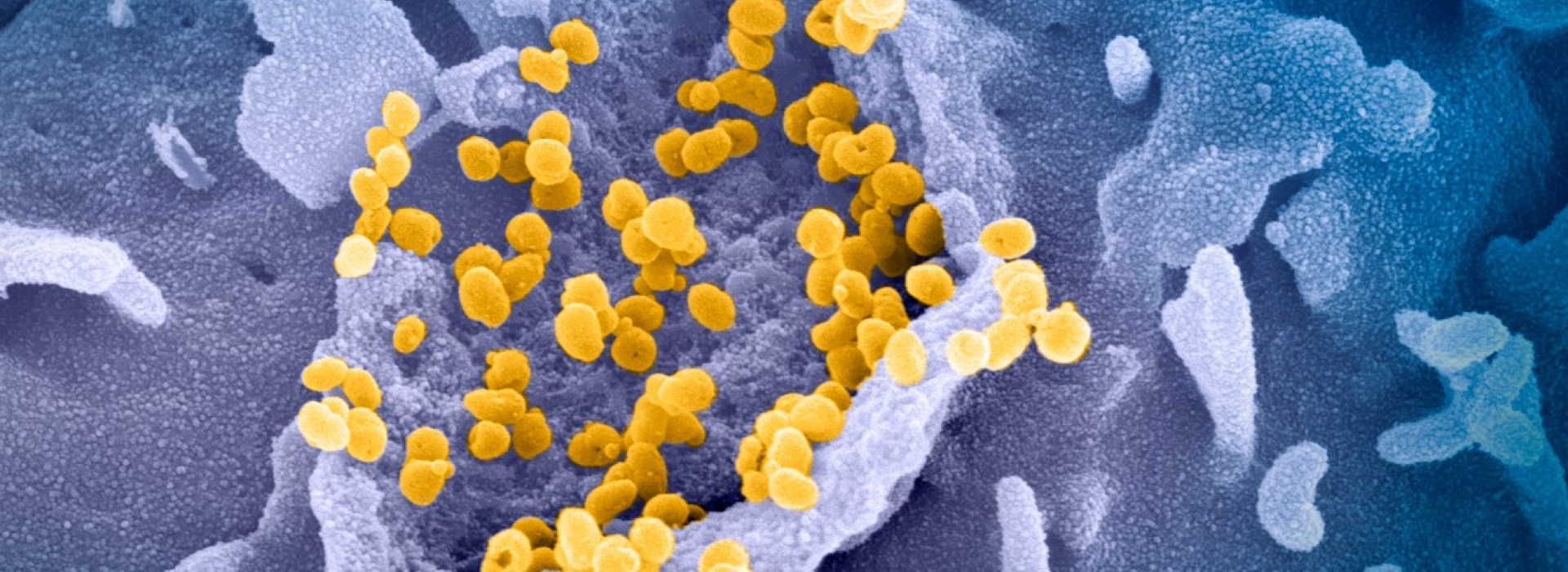 Cell infected by SARS-CoV-2 virus particles, SEM