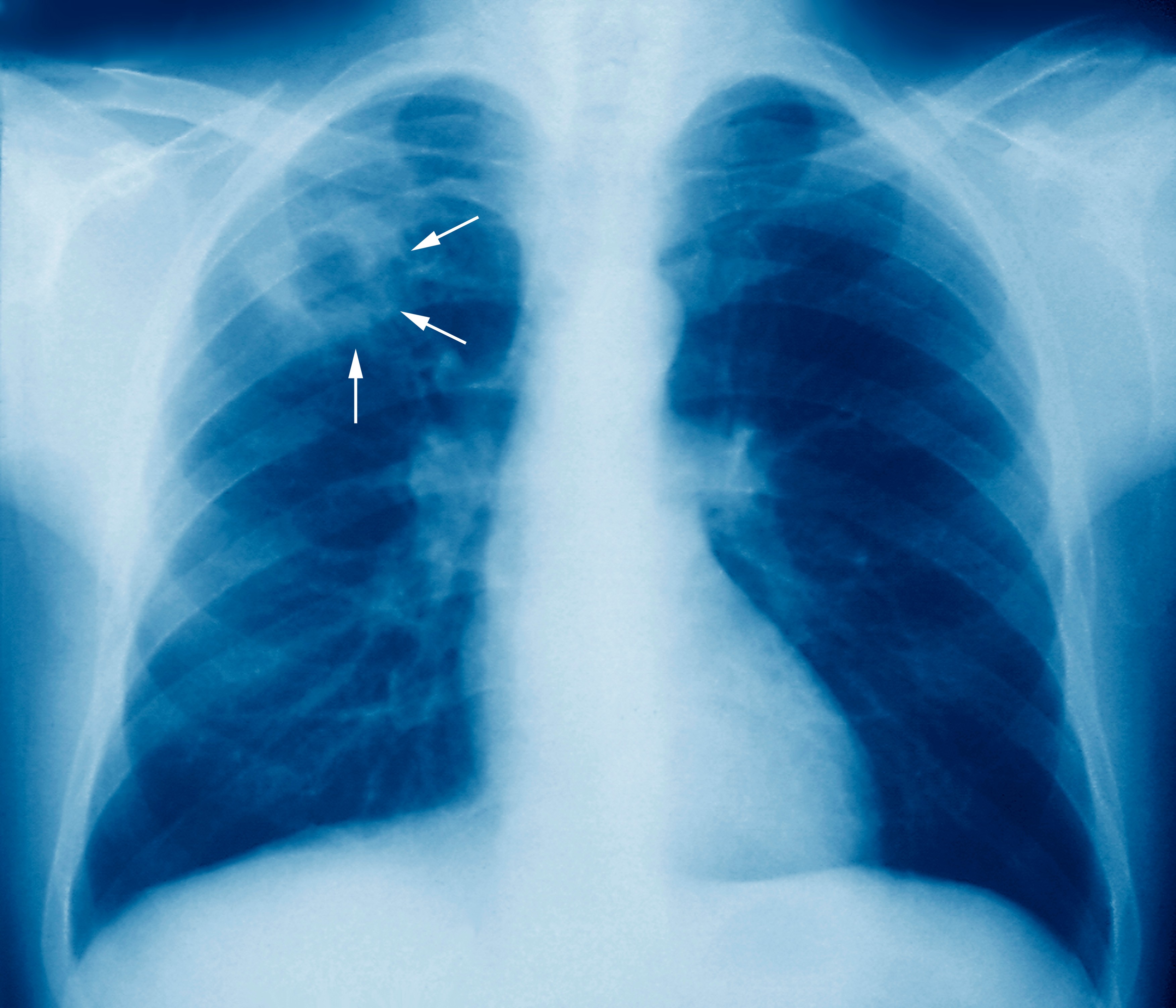 Harta neagră a incidenței cazurilor de tuberculoză. Familii întregi se îmbolnăvesc, iar aparatura modernă stă în cutii, sub cheie
