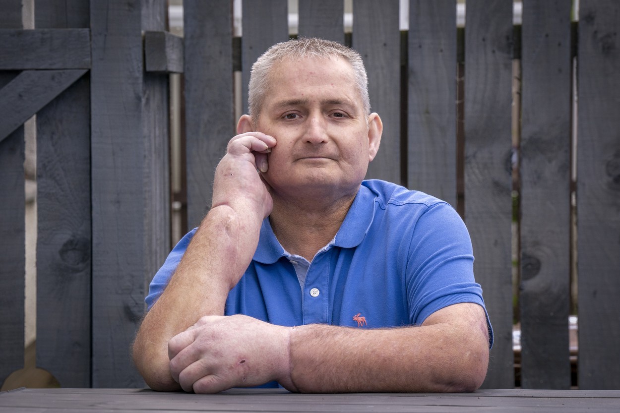 Primul pacient din lume care a suferit un dublu transplant de mână, din cauza unei boli autoimune. Bărbatul își povestește experiența