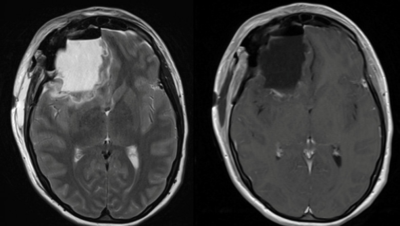 cancer cerebral tomografie