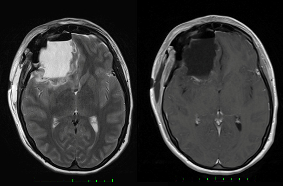 Misterul din New Jersey. Peste 100 de absolvenți ai aceluiași liceu au făcut o formă rară de cancer cerebral
