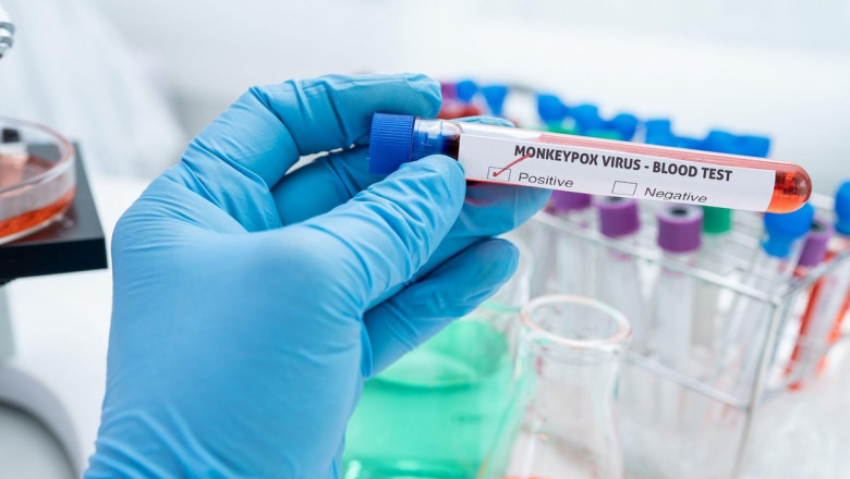 Încă un caz de variola maimuței, al 6-lea, a fost diagnosticat în România