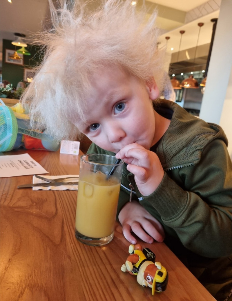 BOY WITH UNCOMBABLE HAIR SYNDROME