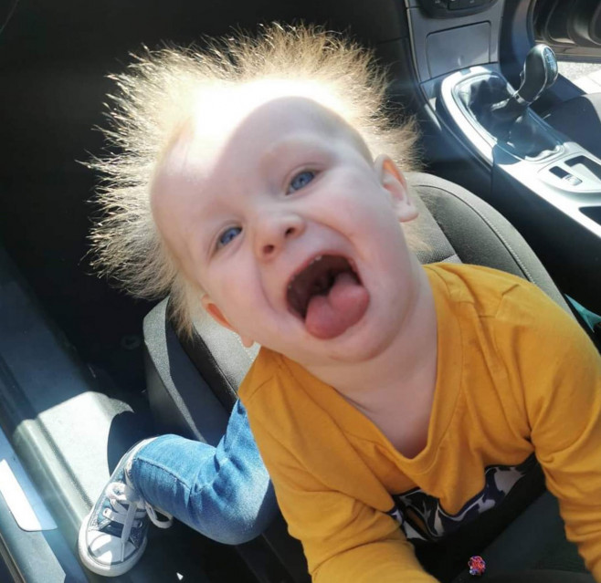 BOY WITH UNCOMBABLE HAIR SYNDROME