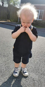 BOY WITH UNCOMBABLE HAIR SYNDROME