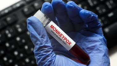 eprubeta cu test de sange pentru variola maimutei