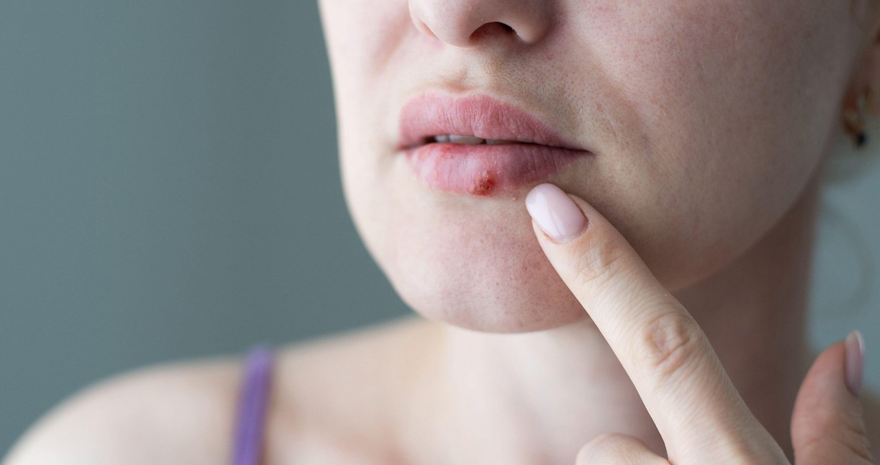 STUDIU. Cum a apărut virusul care provoacă herpesul facial. Ar putea avea o vechime „surprinzătoare” de doar 5.000 de ani