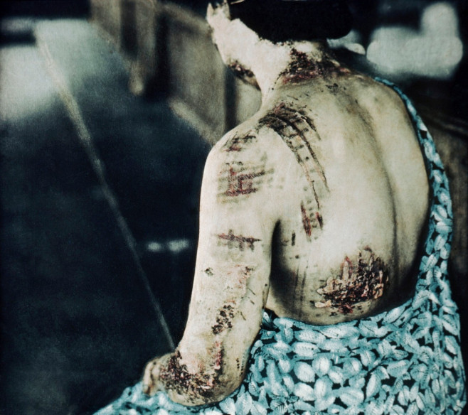 Radiation burns, Hiroshima, 1945