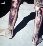 Radiation burns, Hiroshima, 1945