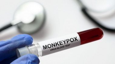 eprubeta test variola maimutei
