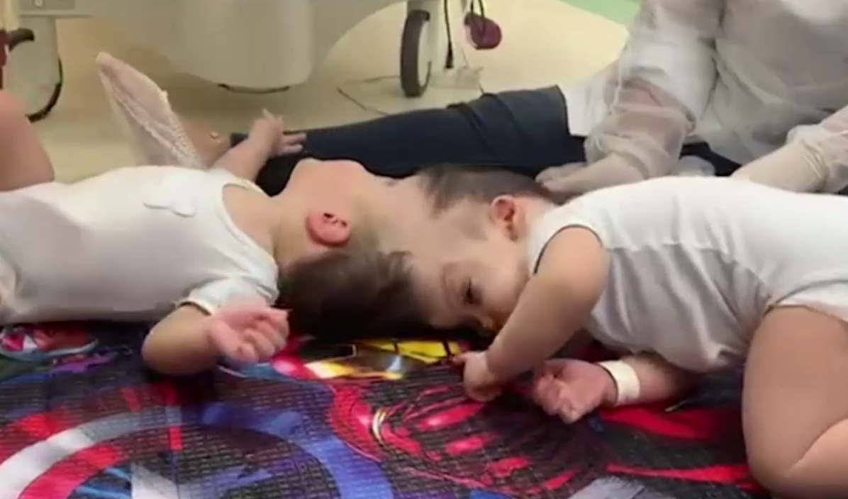 VIDEO. Siamezi care erau uniți în zona capului, despărțiți cu succes după o operație de 27 de ore